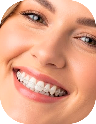 Brackets Cerámicos - Orthosmile - Miraflores - Lima.