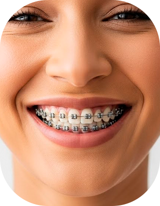 Brackets Metálicos - Orthosmile - Miraflores - Lima.