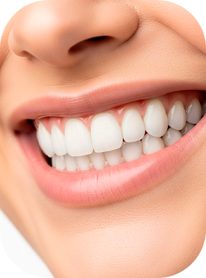 Carillas Dentales - Orthosmile - Miraflores - Lima.